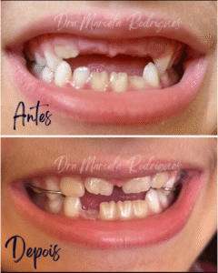 Correção de Dentes Permanentes retidos em criança ( Atresia Maxilar)