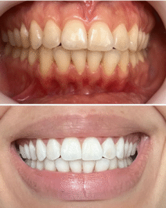 Resultado do Clareamento Dental Expert