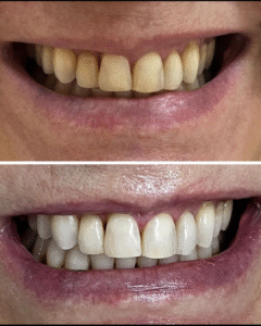 Resultado do Clareamento Dental Expert