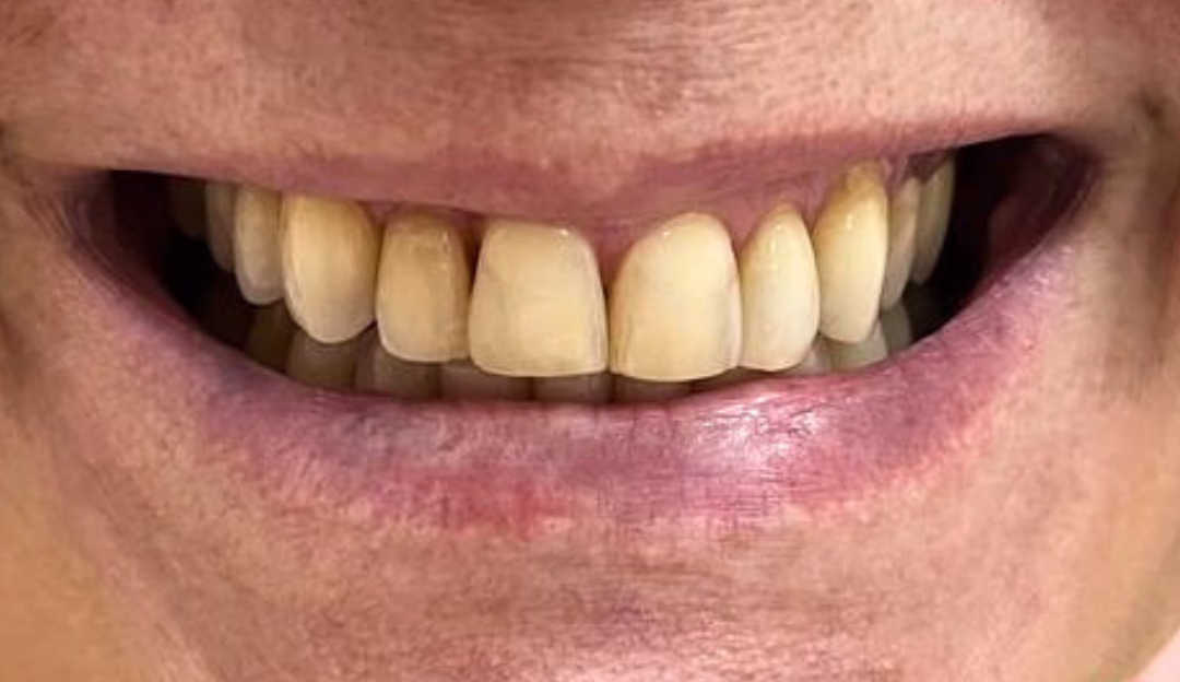 clareamento Dentista em Fortaleza #2 7 1 2