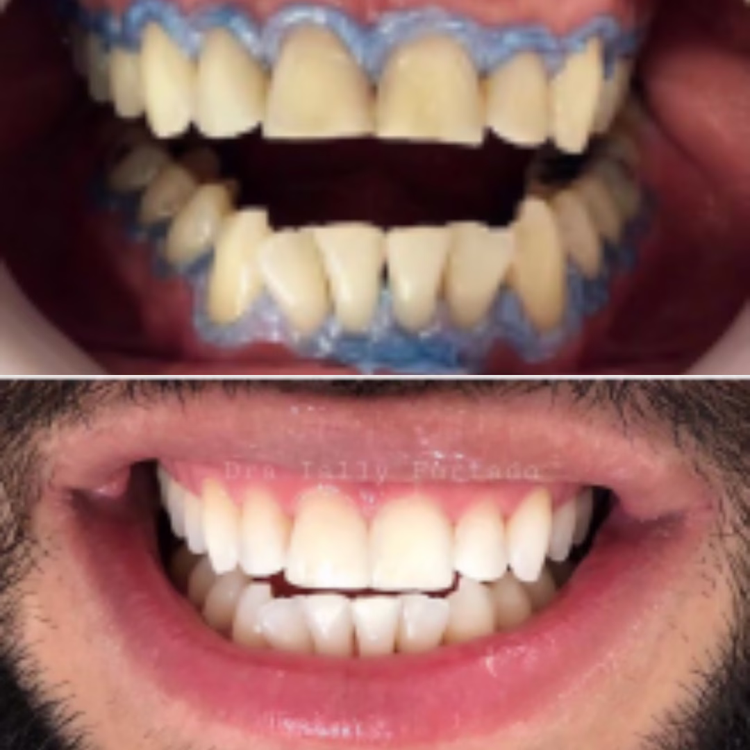 clareamento Dentista em Fortaleza #2 17 11