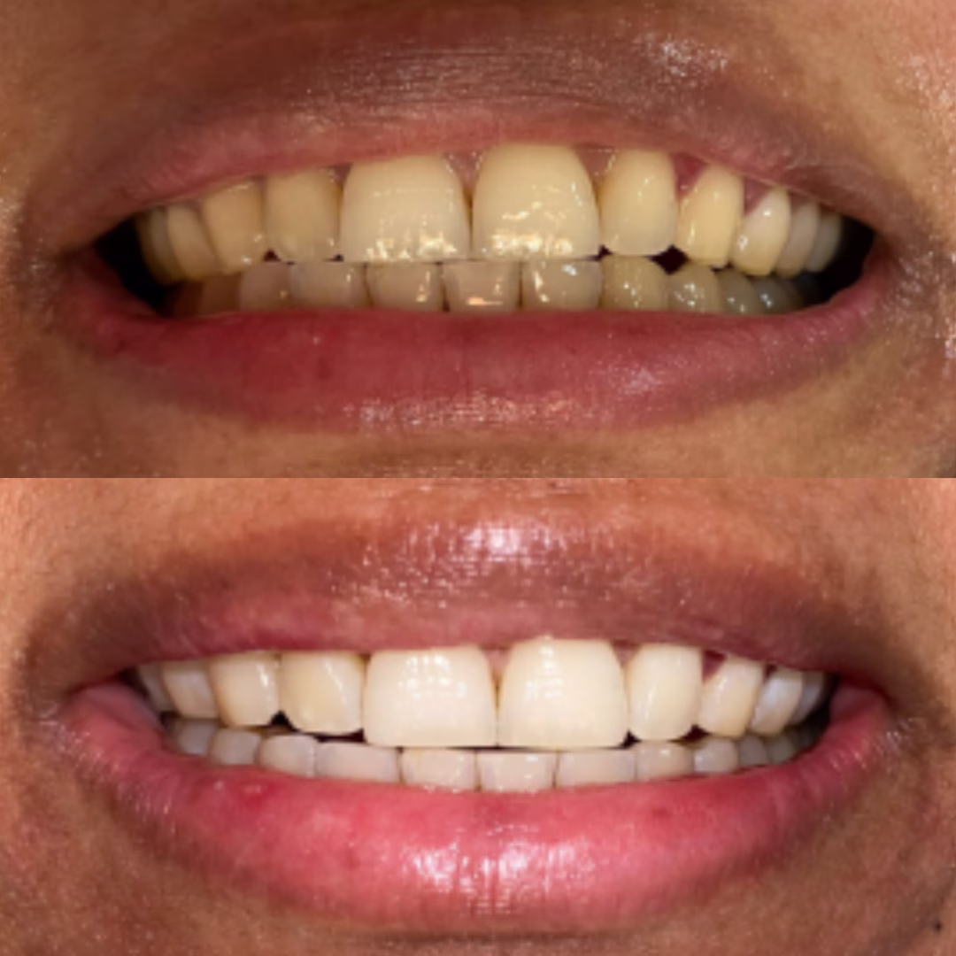 clareamento Dentista em Fortaleza #2 16 12