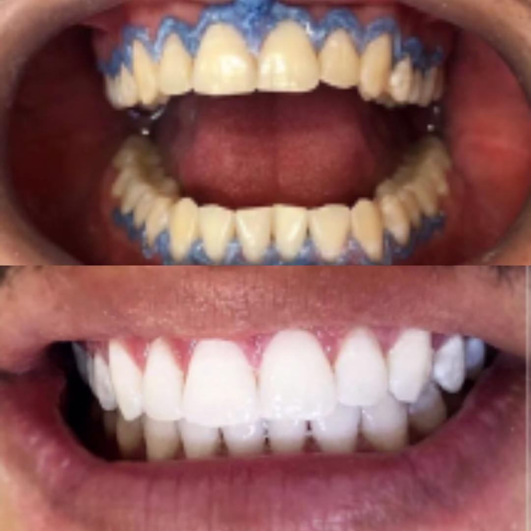 clareamento Dentista em Fortaleza #2 15 13