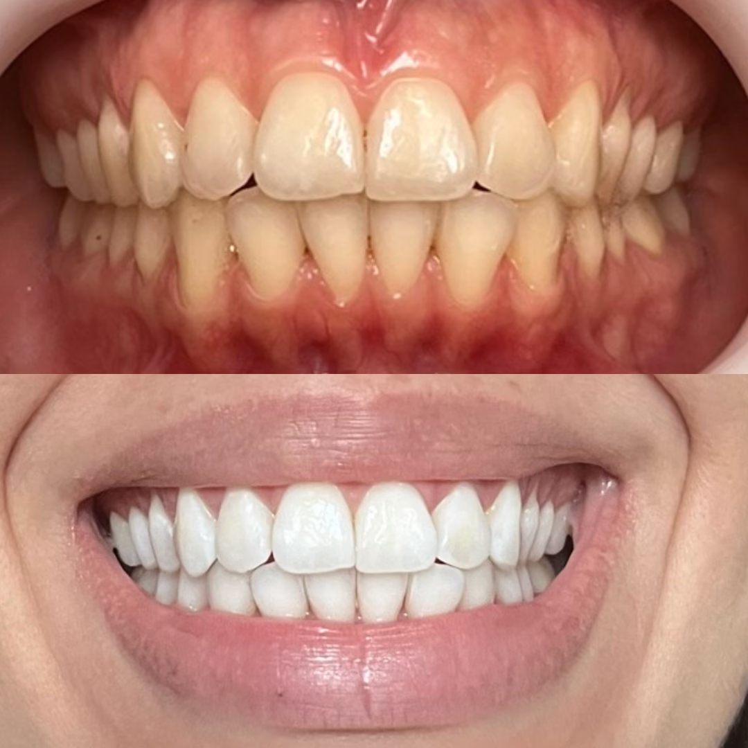 clareamento Dentista em Fortaleza #2 14 7