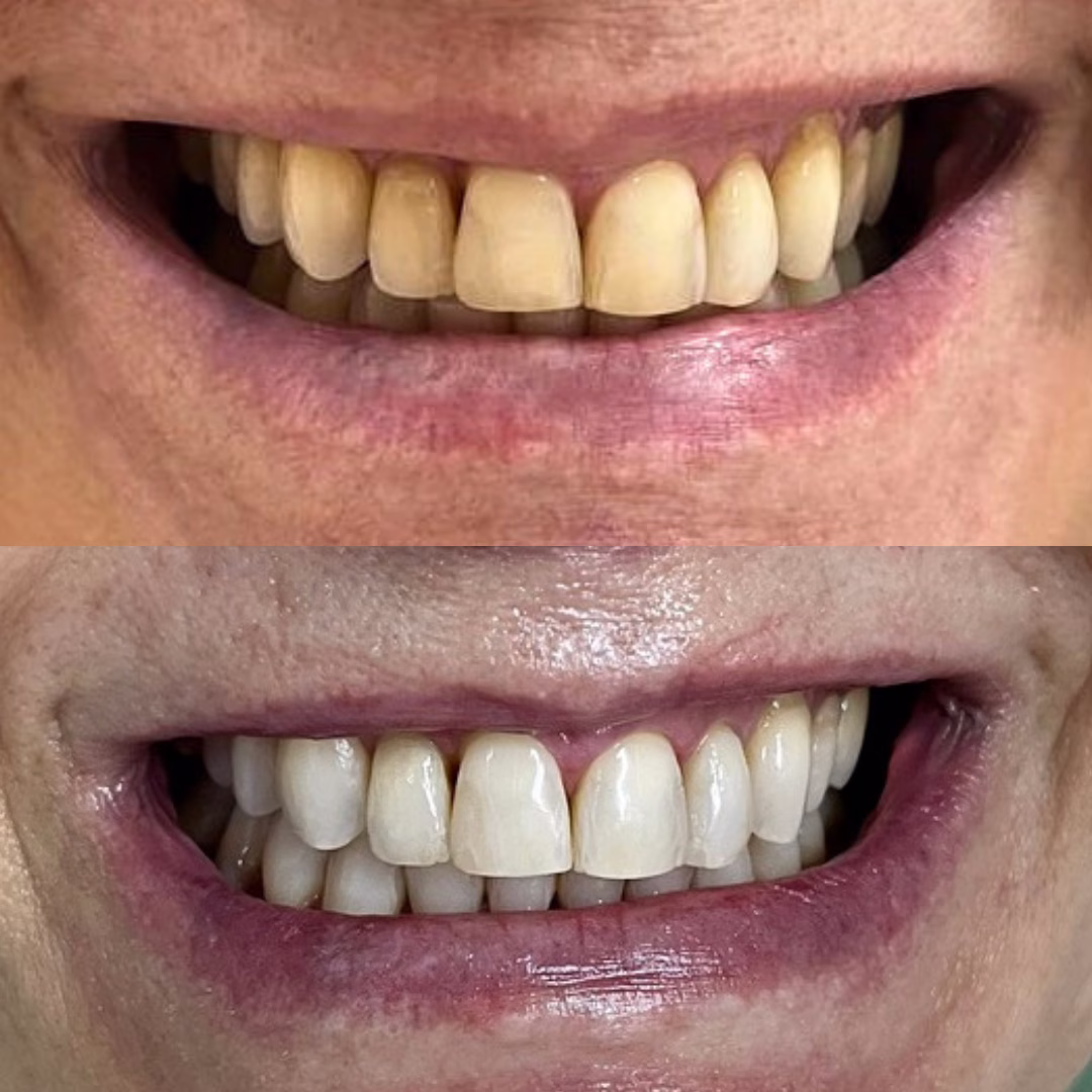 clareamento Dentista em Fortaleza #2 20 8