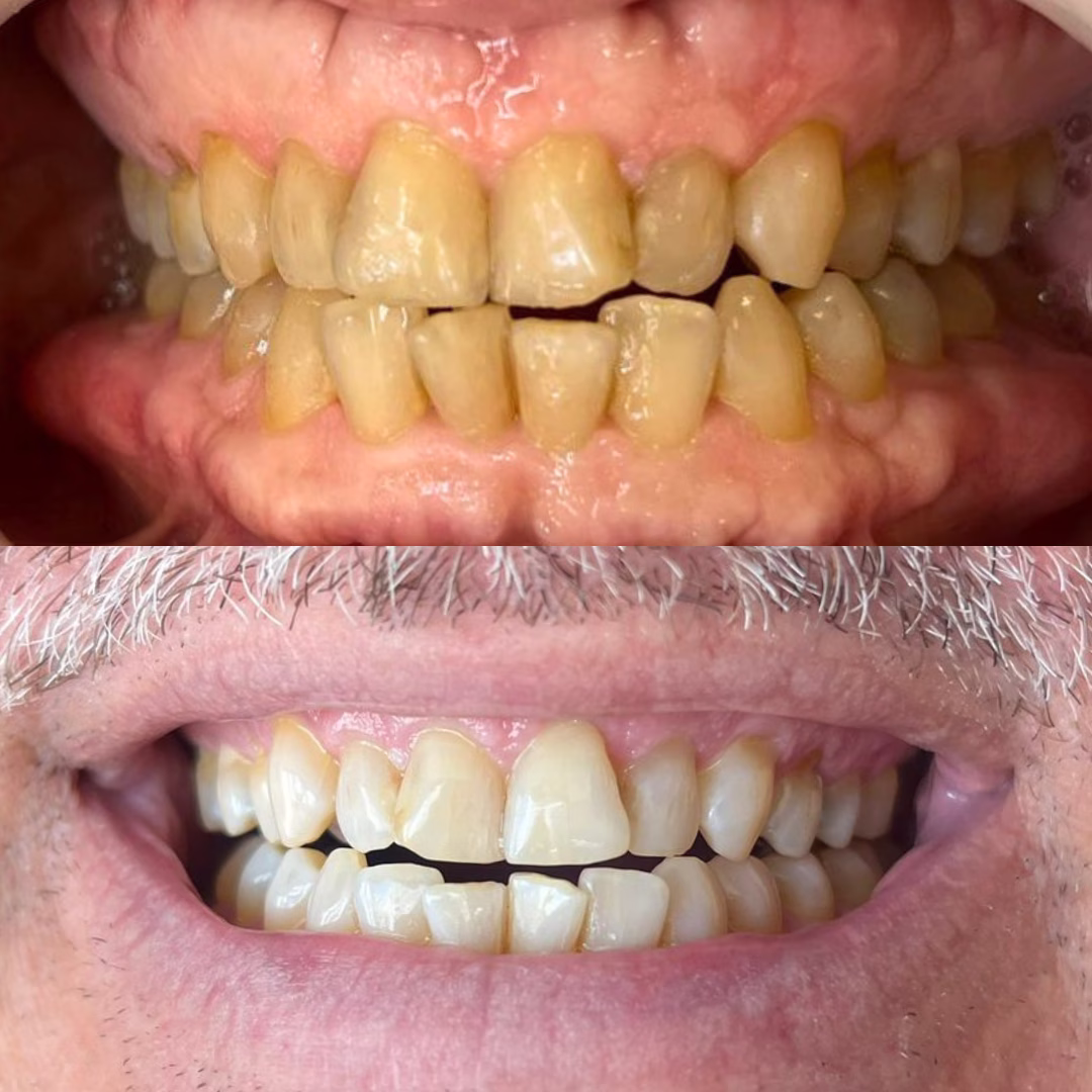 clareamento Dentista em Fortaleza #2 19 9