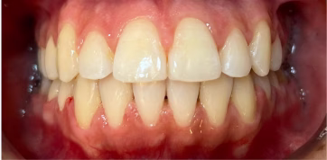 clareamento Dentista em Fortaleza #2 5 Captura de tela 2025 11 15 232537