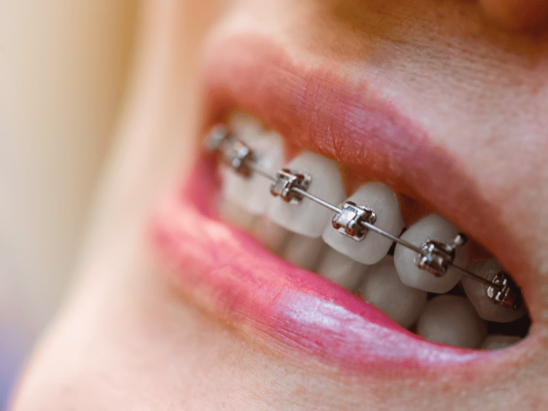 Modelo dentário com aparelho autoligado mostrando brackets metálicos com sistema de clipe de autoligação integrado
